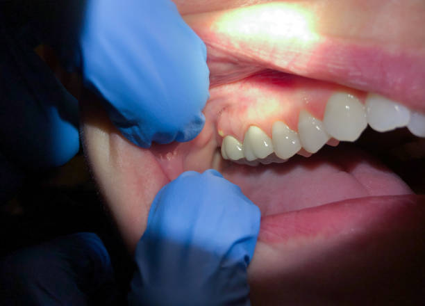 Best Knocked-Out Tooth Emergency  in Kalama, WA